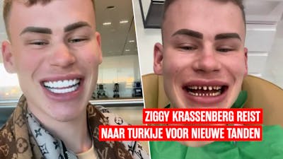 Ziggy Krassenberg reist naar Turkije voor nieuwe tanden