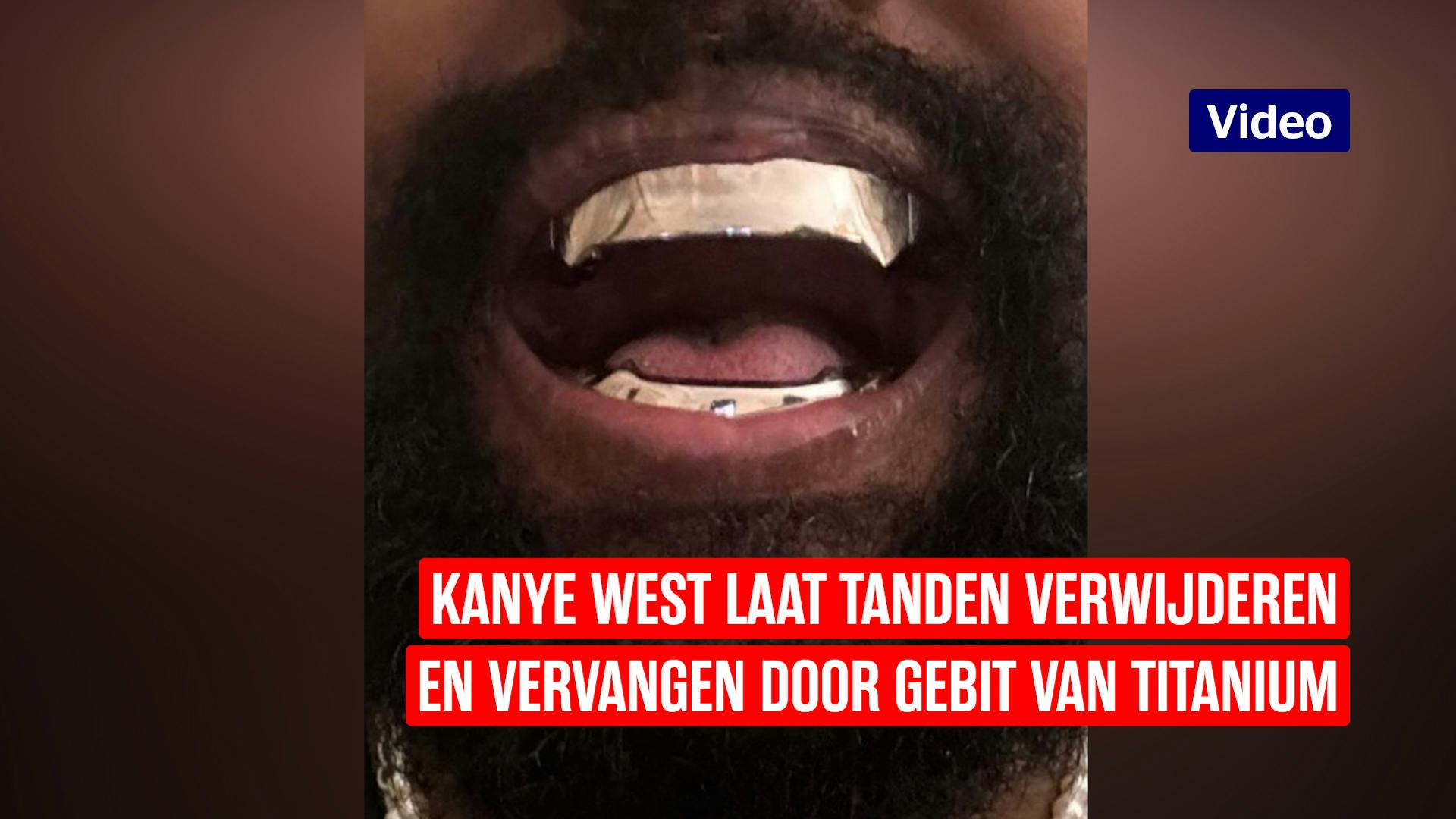 Kanye West heeft gebit van titanium